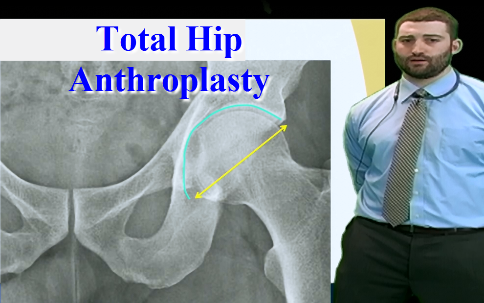 Subspecialties: Orthopedics - Total Hip Anthroplasty - Anatomy Guy